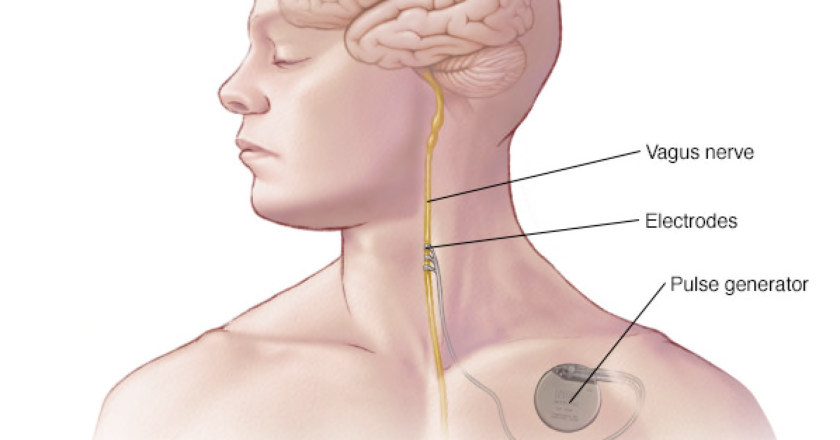 Dolphin Vagal Nerve Stimulator (VNS) for emergency use in the acute treatment for COVID Longhaulers